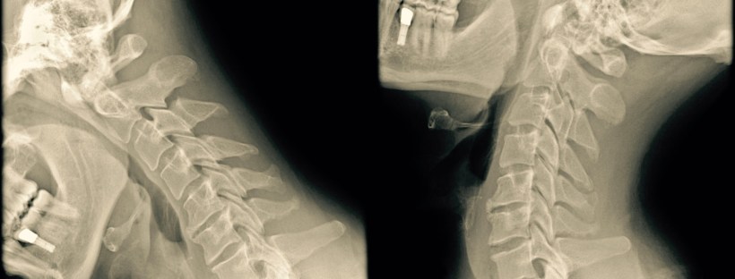 radiographie cervicale avec mouvement